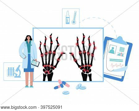Pain And Inflammation In Woman Hand. Rheumatoid Arthritis Symptom On Human Joints And Bones. Doctor 