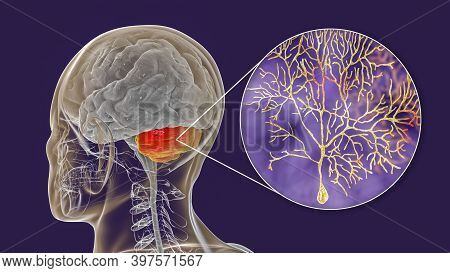 Human Brain With Highlighted Cerebellum And Close-up View Of Purkinje Neurons, One Of The Commonest 