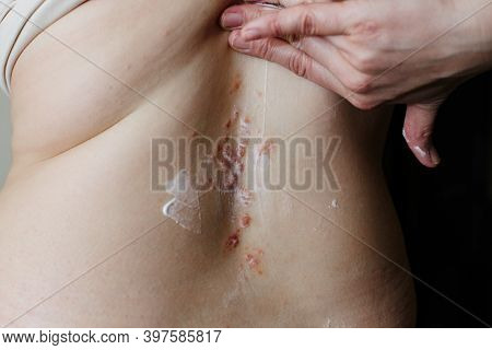 Applying An Emollient To Dry Flaky Skin As In The Treatment Of Psoriasis, Eczema And Other Dry Skin 