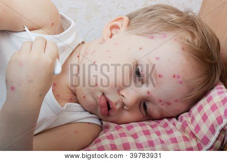 Podobizna chlapce s planými neštovicemi