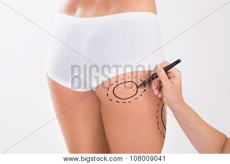 Surgeon Preparing Woman For Liposuction Surgery On Thigh