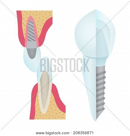 Set of dental crowns and implantation prosthodontics elements and tools. Vector flat illustration.