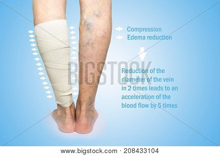 The female legs. Varicose veins. Phlebeurysm. Thrombophlebitis and elastic bandage