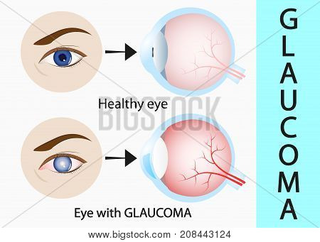 Glaucoma and healthy eye detailed structure. vector