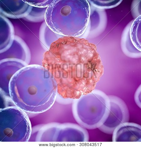 3d rendered illustration of a cancer cell among healthy cells