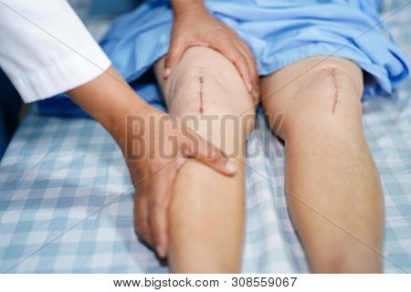 Asian Senior Or Elderly Old Lady Woman Patient Show Her Scars Surgical Total Knee Joint Replacement 