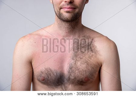 Handsome Man With A Lot Of Black Hair On One Side Of The Chest And Another Part Of The Breast After 