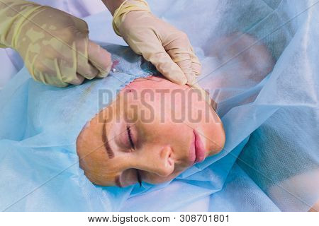 Aged Woman Doing Mesothreads And Thread Lifting, Cosmetology. Cosmetic Procedure To Eliminate Signs 