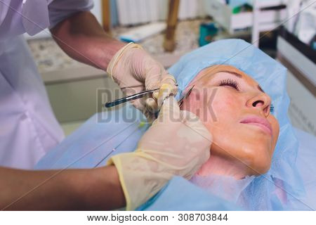 Aged Woman Doing Mesothreads And Thread Lifting, Cosmetology. Cosmetic Procedure To Eliminate Signs 