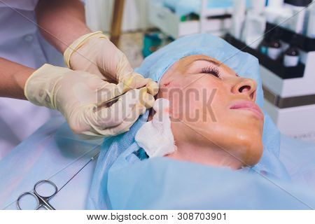 Aged Woman Doing Mesothreads And Thread Lifting, Cosmetology. Cosmetic Procedure To Eliminate Signs 