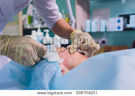 Aged Woman Doing Mesothreads And Thread Lifting, Cosmetology. Cosmetic Procedure To Eliminate Signs 
