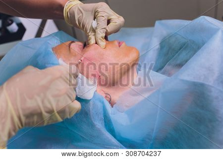Aged Woman Doing Mesothreads And Thread Lifting, Cosmetology. Cosmetic Procedure To Eliminate Signs 