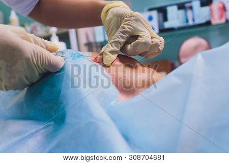 Aged Woman Doing Mesothreads And Thread Lifting, Cosmetology. Cosmetic Procedure To Eliminate Signs 