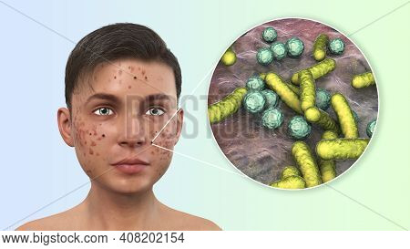 Acne, Pimples, And Closeup View Of Bacteria, The Causative Agents Of Skin Lesions