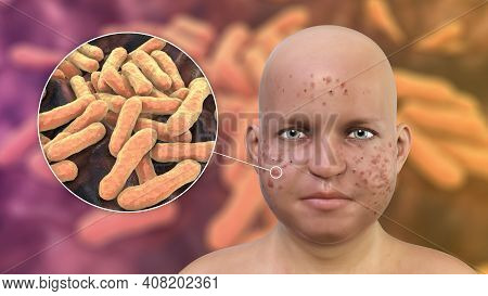 Acne Vulgaris In An Overweight Person And Closeup View Of Bacteria Cutibacterium Acnes