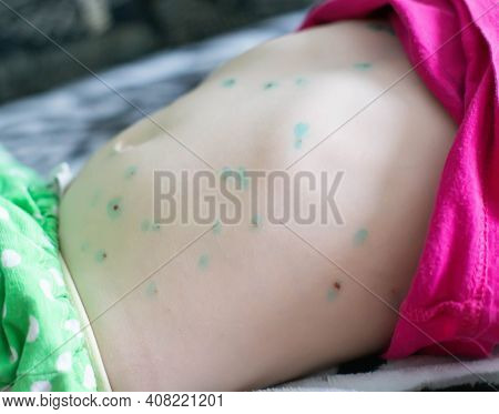 A Rash On The Skin Of The Abdomen In A Child Infectious Disease Chickenpox, Incubation Period