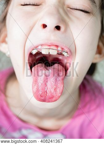The Doctor Examines The Childs Throat. Little Girl Opened Her Mouth Wide To Show Sore Throat