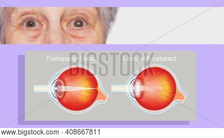 Cataract Concept. Senior Woman's Eye, Closeup