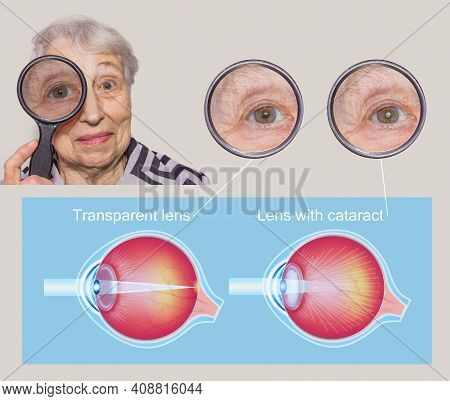 Cataract Concept. Senior Woman's Eye, Closeup