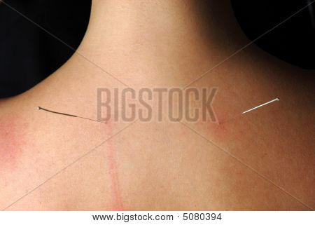 Alternativní terapie: Acupunture