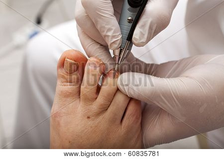 Edit Toenail With Grinder