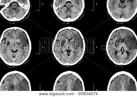 Ischemic Stroke