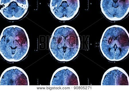 Ischemic stroke