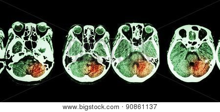 Stroke  ( Ct Scan Of Brain And Base Of Skull And Stroke )