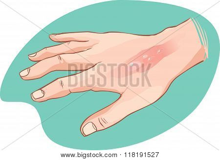 White Background Vector Illustration Of A  Hand Burn
