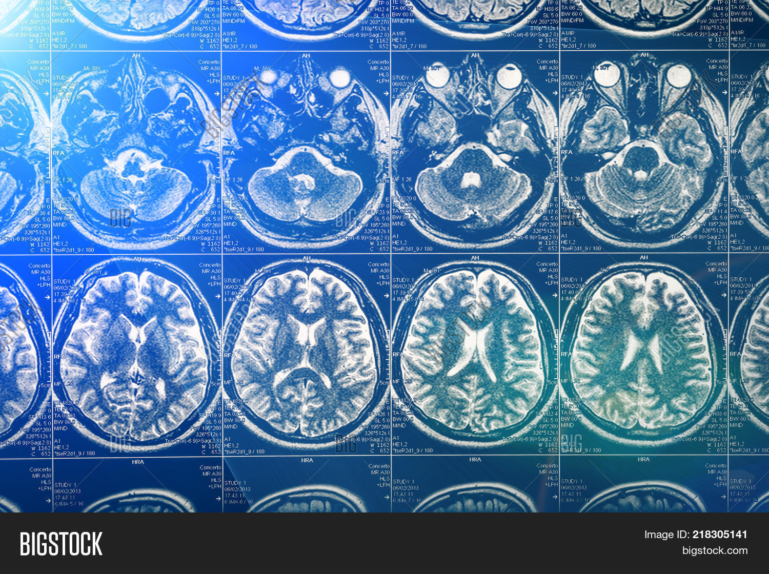Brain Scan X-ray Mri Image & Photo (Free Trial) | Bigstock