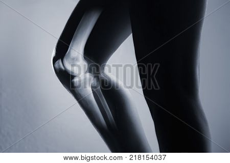 Human Knee Joint And Leg In X-ray