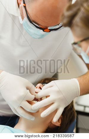 Close Up Process Of Preparing And Installing Dental Ceramic Crown. Male Professional Dentist Helps T