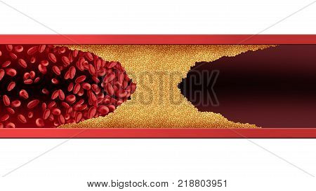 Blocked blood vessel human artery disease with cholesterol buildup clogging or blocking circulation flow with 3D illustration elements.