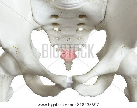 3d rendered medically accurate illustration of a broken coccyx