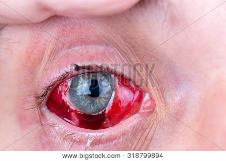 Postoperative Heavy Inflamed Eye Closeup Shot With Selective Focus
