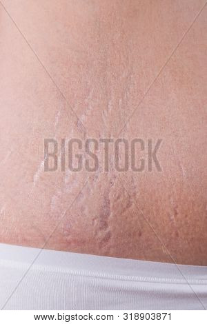 Female Belly With Stretch Marks Closeup