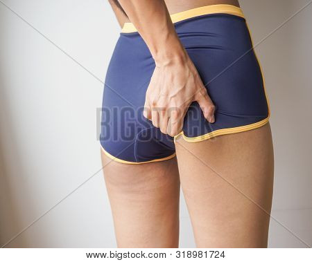 Woman Buttocks With Cellulite, Orange Peel, Checking Cellulite.