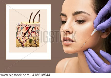 Mesothreads. Face Contour Lifting Procedure. Needle With Meso Threads Near A Female Face