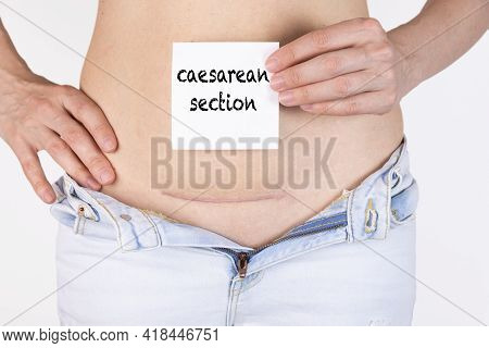 Woman Belly With Scar And Caesarean Section Text On White Sticker. Five Months After Surgery.
