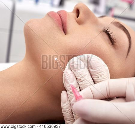 Woman Receives A Facelift, Procedure Mesothreads Lifting Skin. Cosmetic Surgery, Meso-threads Lift, 