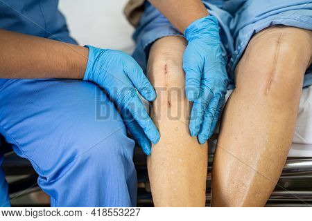 Asian Senior Or Elderly Old Lady Woman Patient Show Her Scars Surgical Total Knee Joint Replacement 