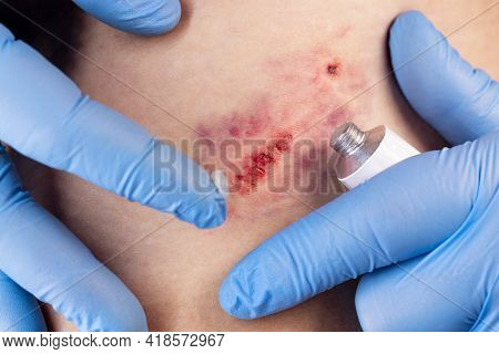 Doctors Hands In Gloves Performs The Treatment The Wound With The Help Of Ointment. Hematoma Of Tiss