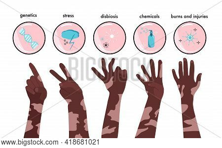 World Vitiligo Day.infographics Icons With Reasons Of Sickness.afro American Hands With Skin Disease