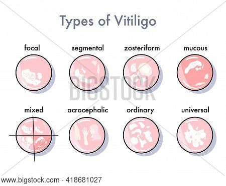 Types Of Vitiligo Infographic Icons Options For The Spread And Manifestation Of The Skin Disease.pig