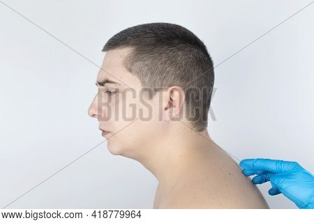 Kyphosis. The Man Suffers From A Curvature Of The Spine In The Upper Section. The Cervical Vertebrae