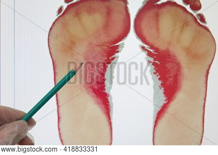 The Doctor Points Out The Signs Of Flat Feet. The Doctors Hand In A Glove Points To The Footprint Wi