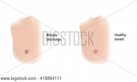 Woman Healthy Breast And Bloody Discharge. Comparison. Medical Vector Illustration.