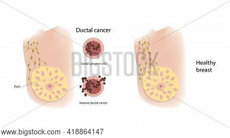 Woman Healthy Breast And Ductal Cancer. Comparison. Medical Vector Illustration.