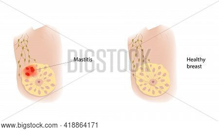 Woman Healthy Breast And Mastitis. Comparison. Medical Vector Illustration.
