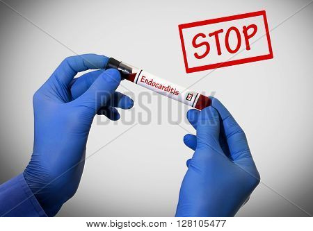Stop endocarditis. Positive result of blood test. Test tube with a blood test in the doctor's hands. Medical concept.